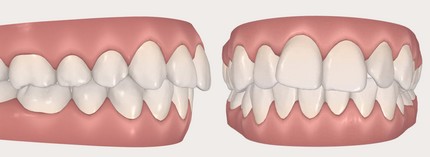 Orthodontie - malocclusion dentaire