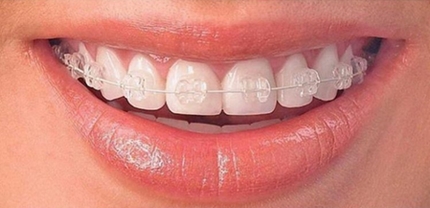 Technique orthodontique vestibulaire multi-bagues avec attaches en céramique et fil invisible