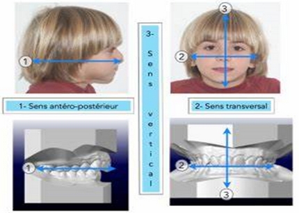 Technique orthodontique chez l’enfant - sens frontal, transversal, sagital