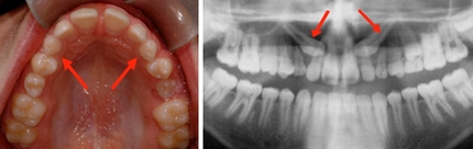 Technique orthodontique chez l’enfant - canines incluses